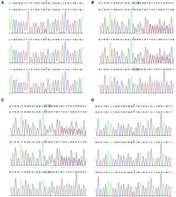 Case report: Diagnosis and treatment of DGAT1 deficiency-induced congenital diarrhea in two cases and literature review